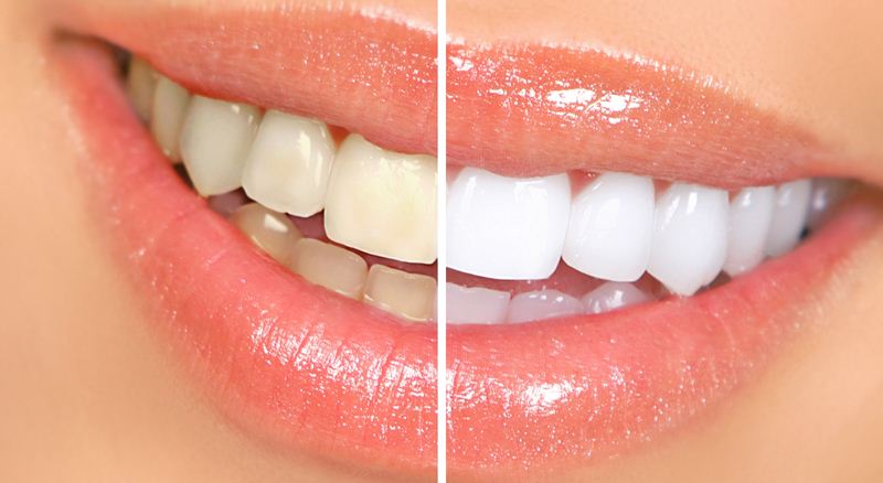 A Diy Recipe For Whiter Teeth In 14